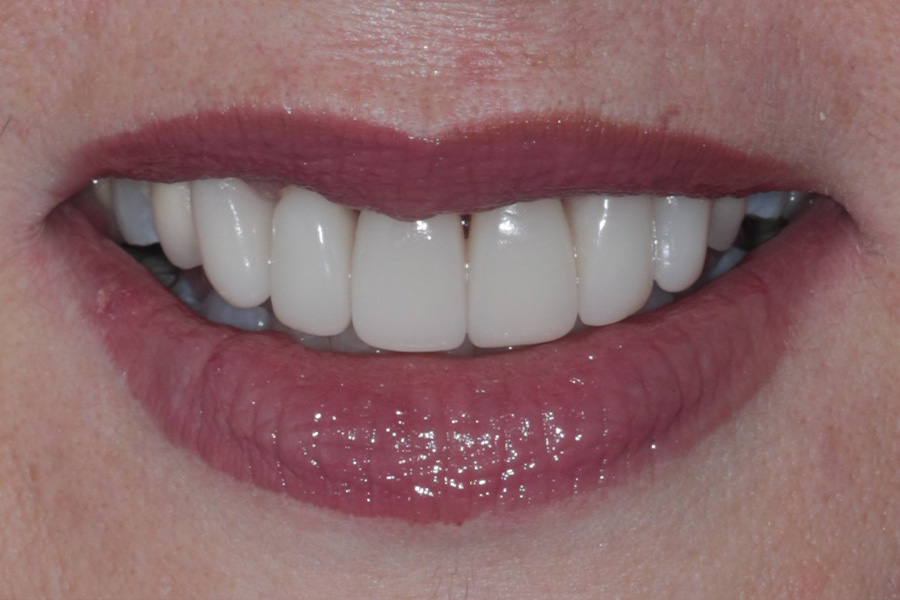 Before & After Discoloured and Decayed Restorations