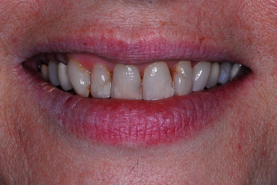 Before & After Discoloured and Decayed Restorations