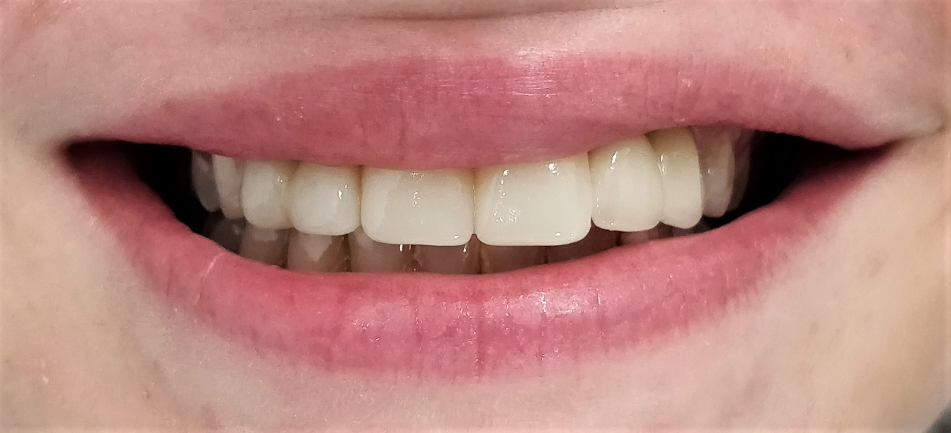 2 Missing Teeth After