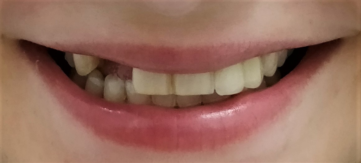 2 Missing Teeth Before