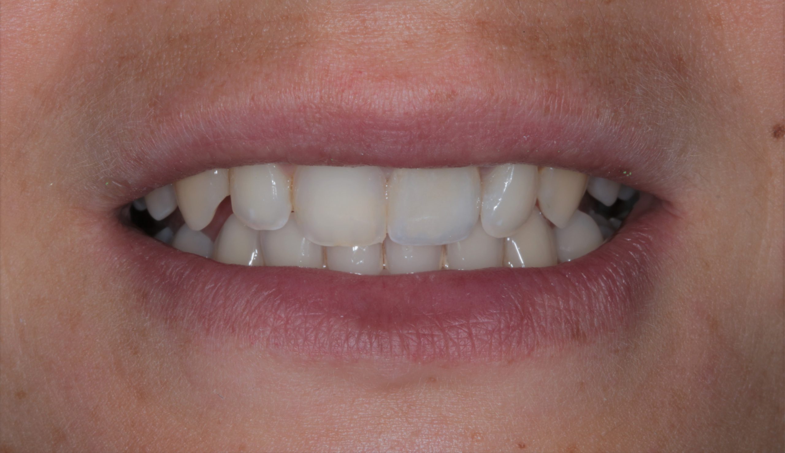 Discoloured Front Teeth After