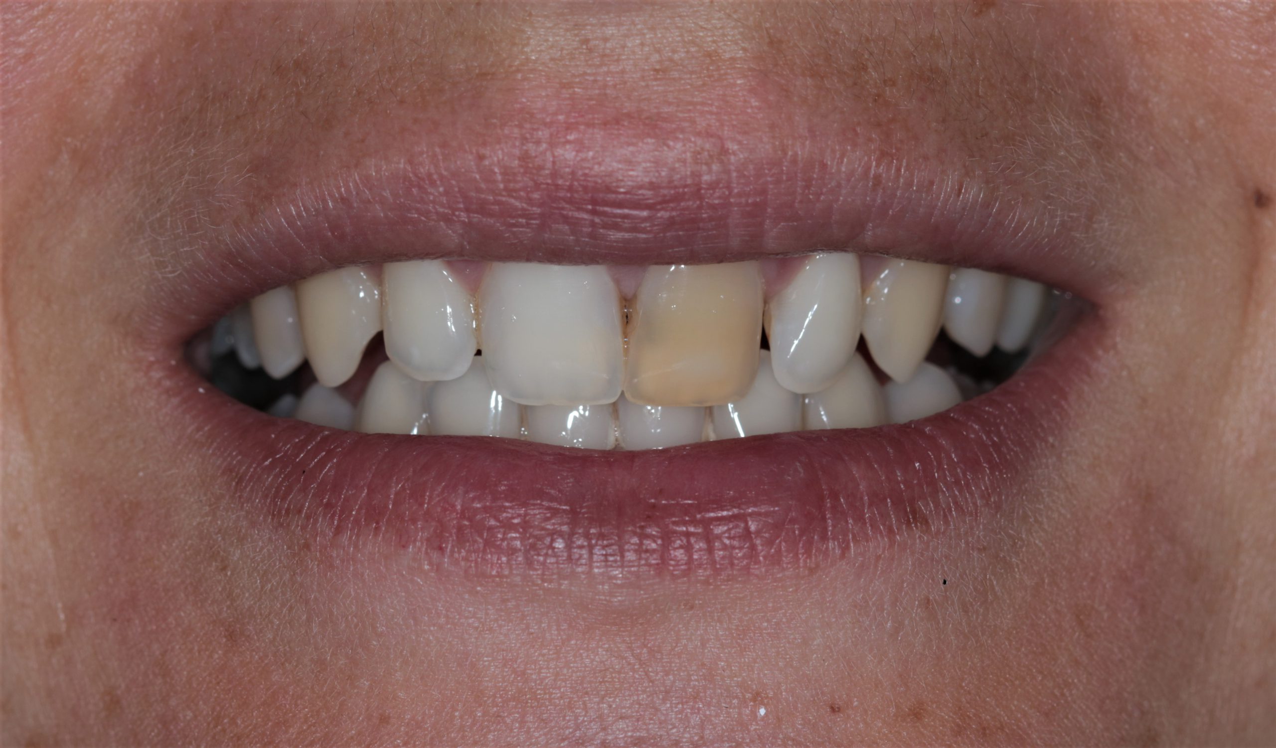 Discoloured Front Teeth Before