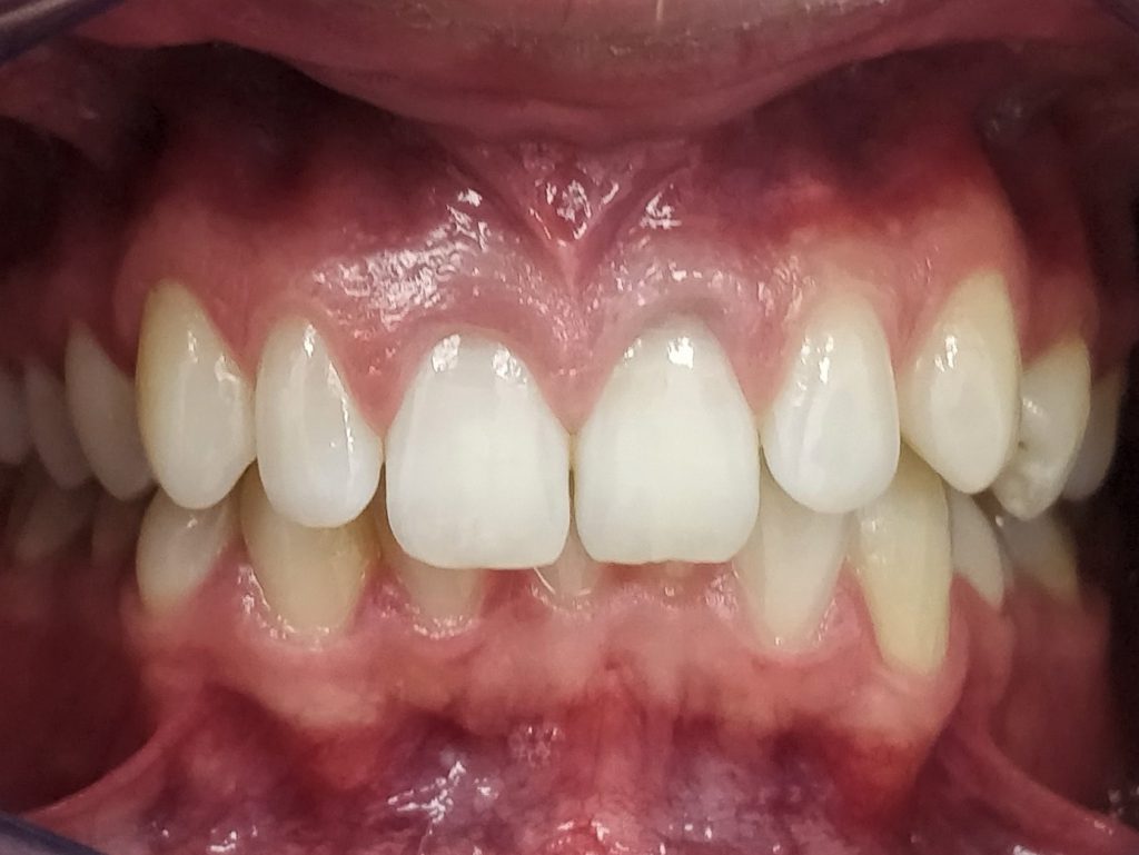 Discoloured Restorations & Decay After