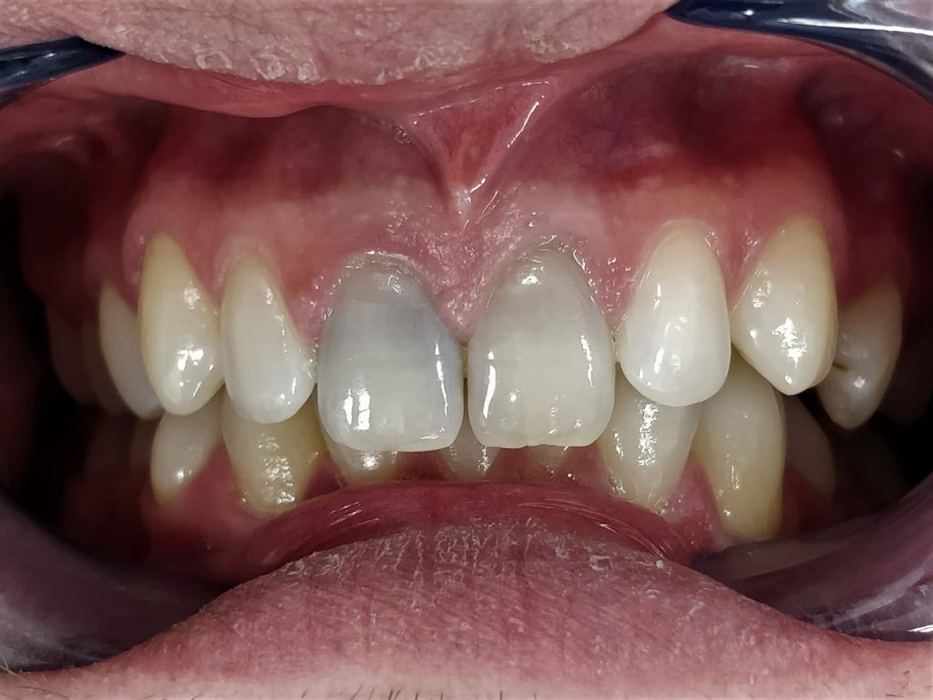 Discoloured Restorations & Decay Before