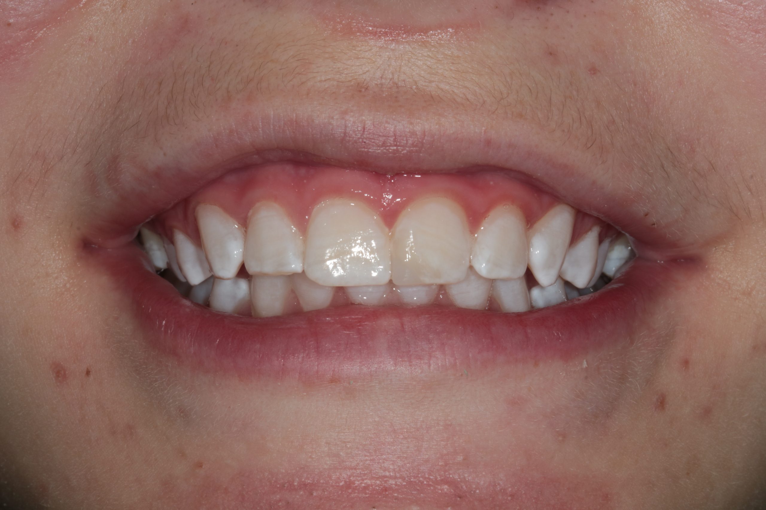 Teeth whitening 2 post