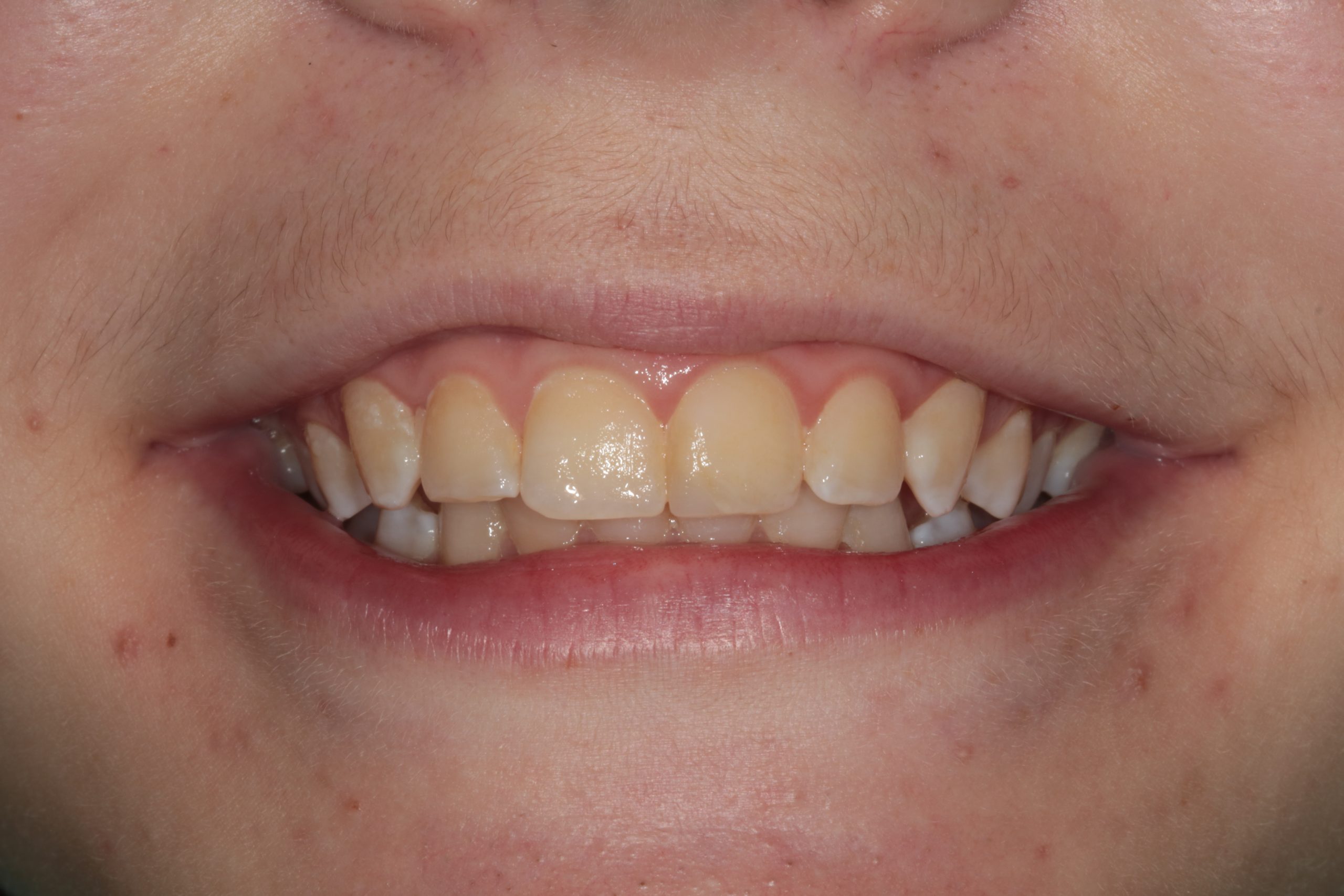 Teeth whitening 2
