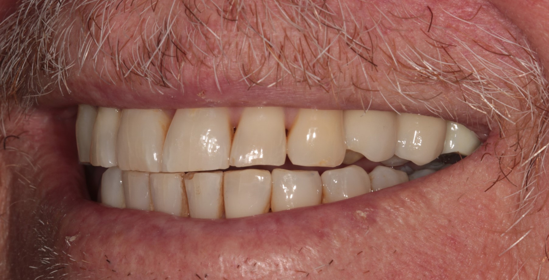 Dental implant after